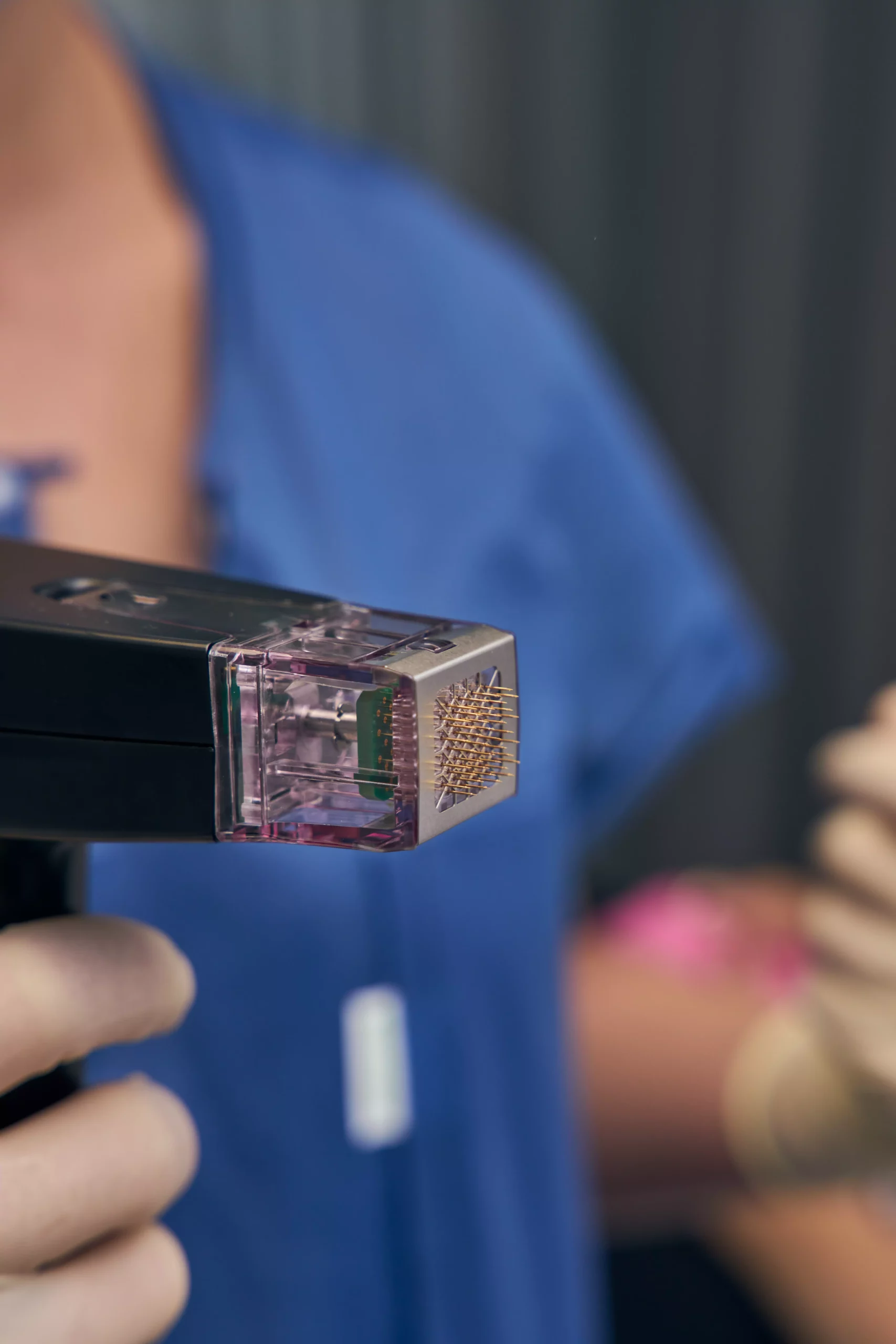 Morpheus8 Microneedling mit Radiofrequenz zur Hautstraffung