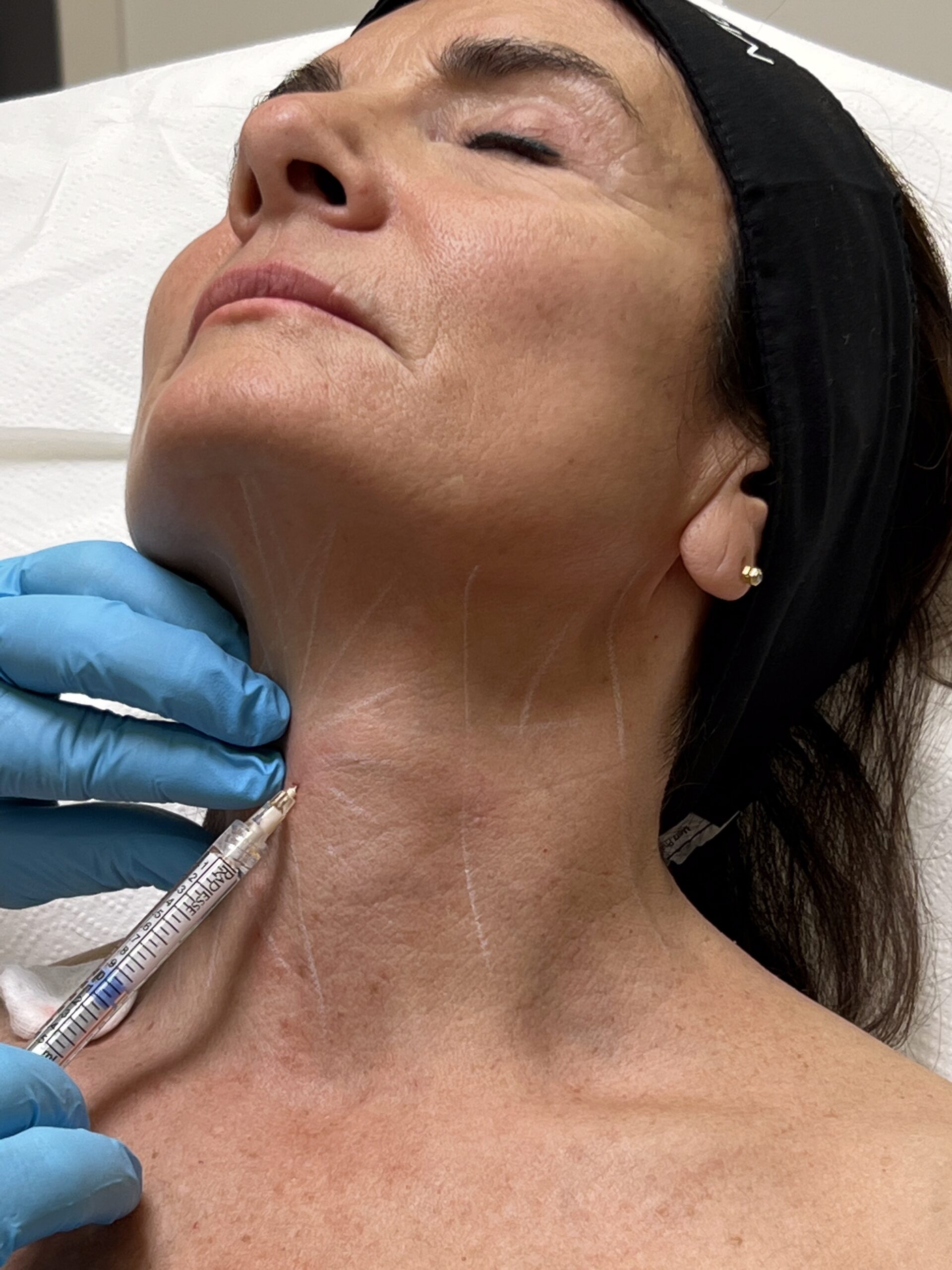 Radiesse Behandlung bei einer Patientin